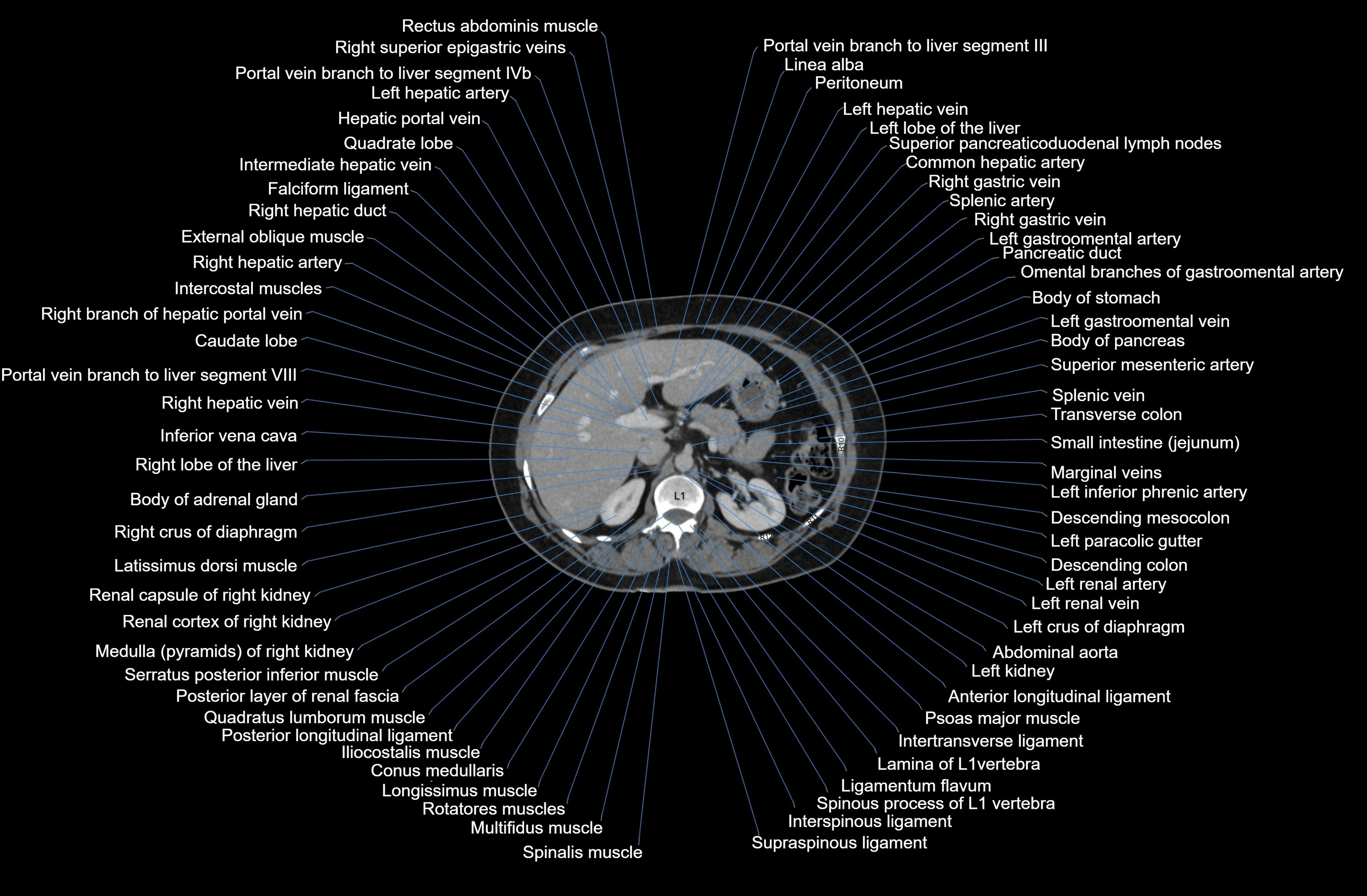 CT Abdomen axial cross sectional anatomy labelled radiology image-00027.webp